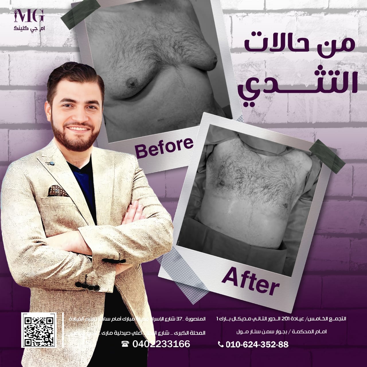 نتيجة تكبير الثدي — تناسق